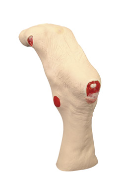 Wound care model of the foot showing pressure ulcer of the heel